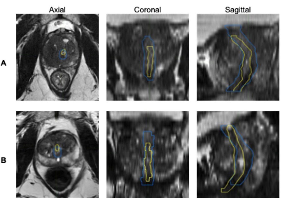 Side‑by‑side MRI images show how an AI system outlines the urethra compared with outlines drawn by a team of medical specialists.
