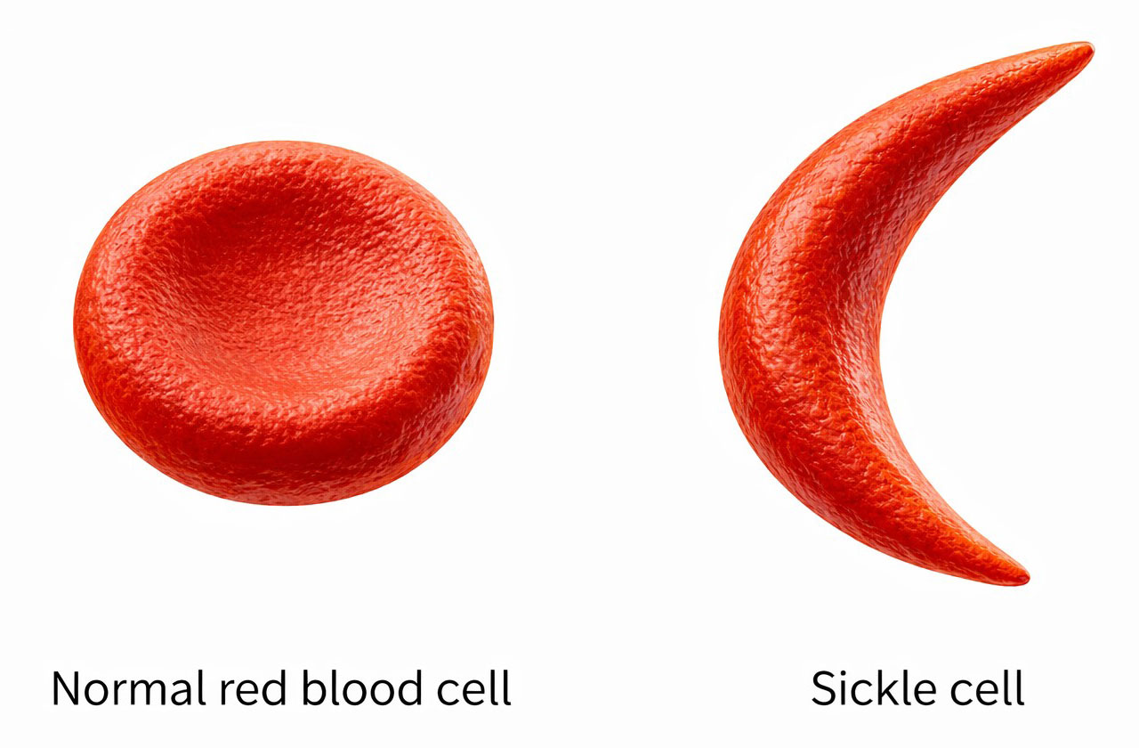 Normal blood cell and sickle cell side-by-side compared.