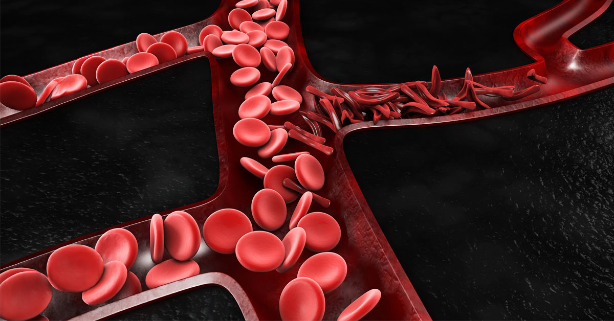 Illustration of normal and sickle blood cells flowing through vessels.